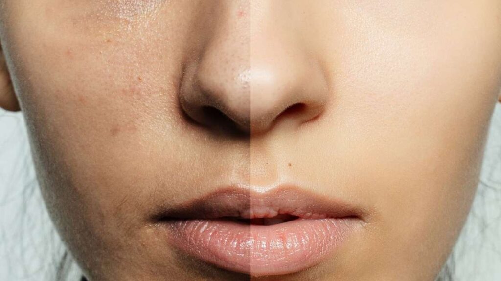 glycolic acid vs salicylic acid