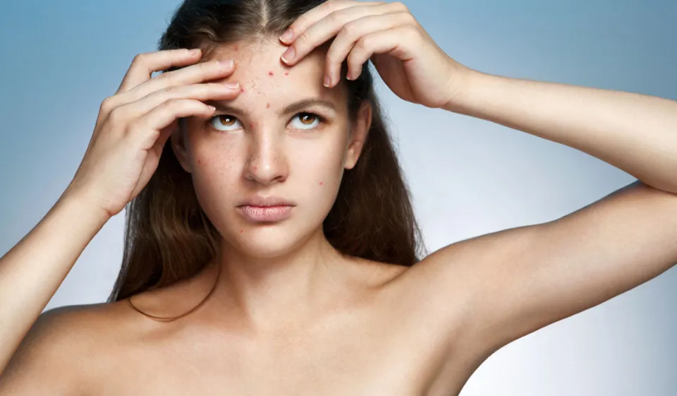 How to Treat Acne Between Eyebrows? Causes & Treatment